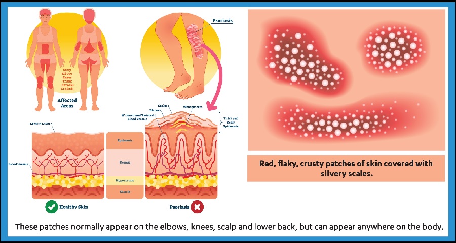 Inverse Psoriasis