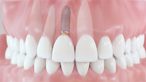 Dental Implant Experiment Good or Bad